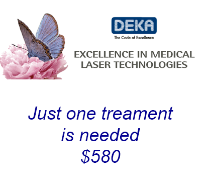 Ilustration of a Deka Laser Technology